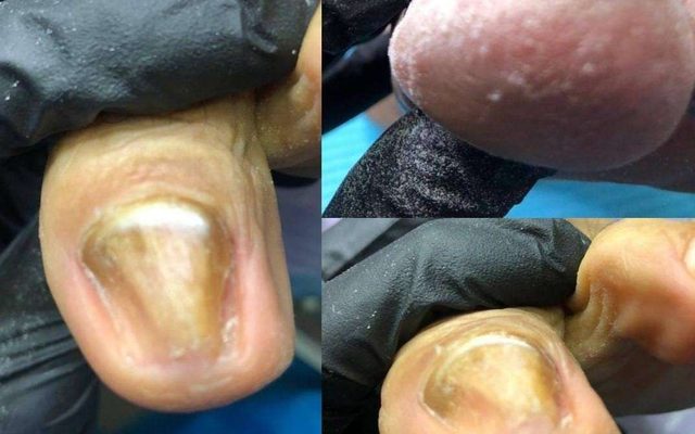 Uñas del pie revisadas de cerca en la consulta de PodoFeet.