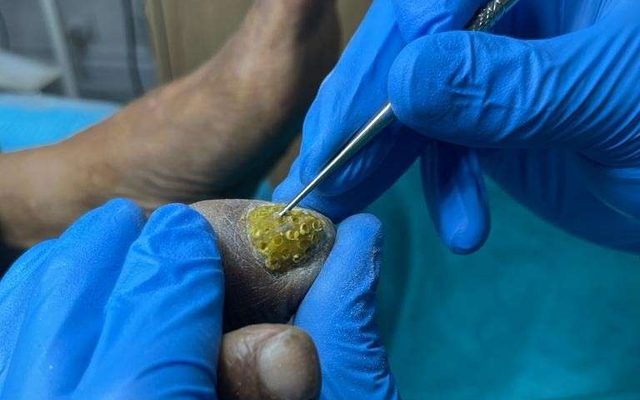 Manos con guantes tratando una uña del pie en la consulta.